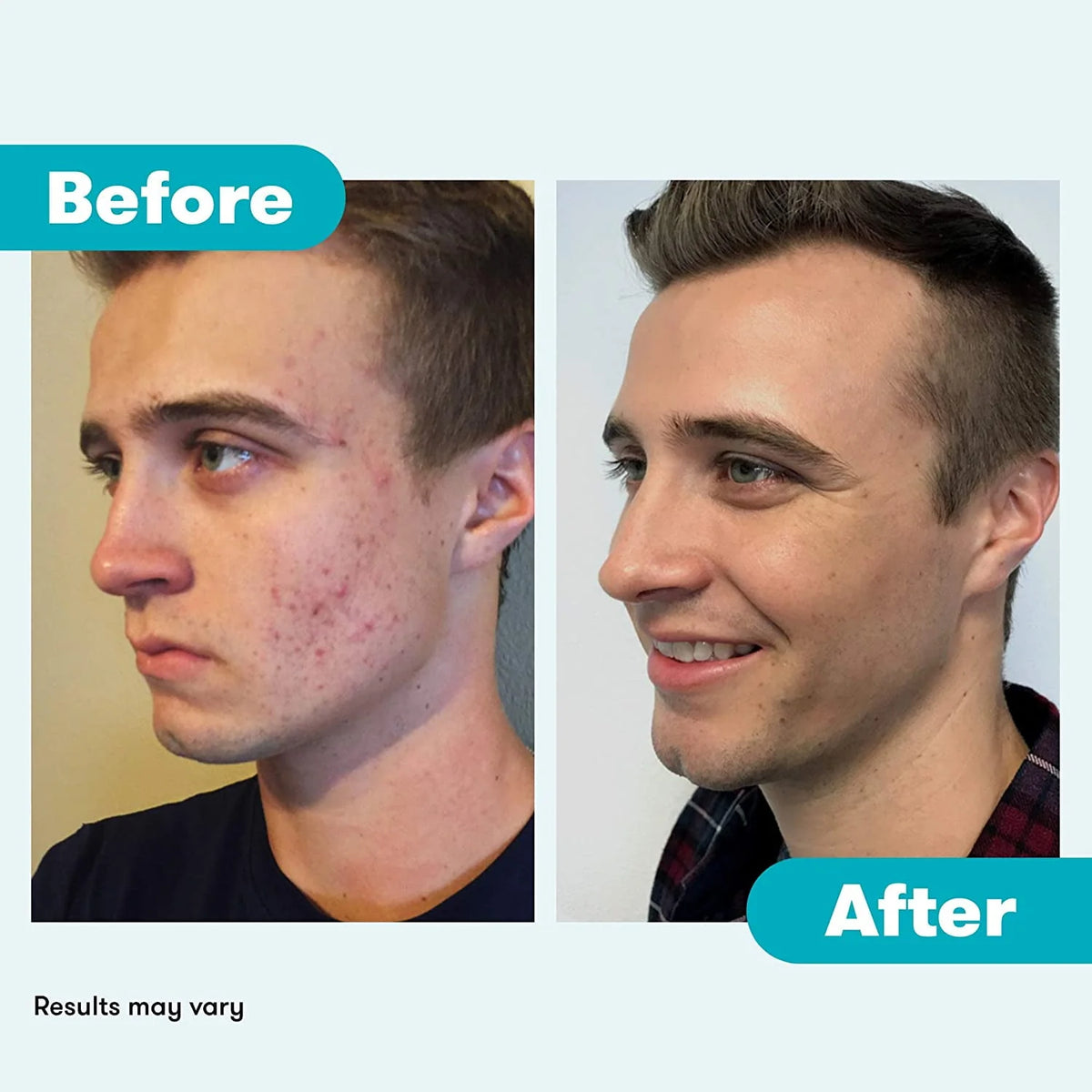 Acne System with Purifying Mask J293